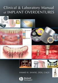 Clinical and Laboratory Manual of Implant Overdentures - Сборник